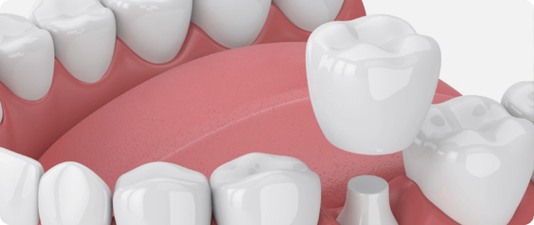 Dental Crowns in New Albany