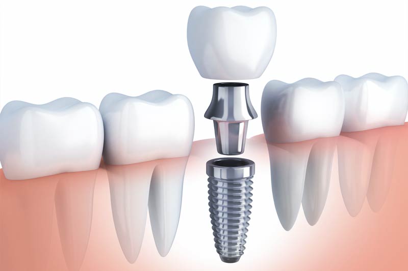 Implant Dentist in New Albany